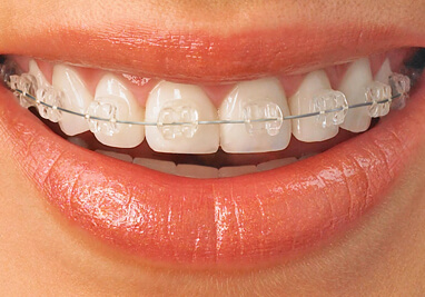 Ceramic Braces