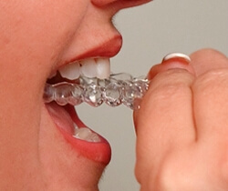 Invisalign